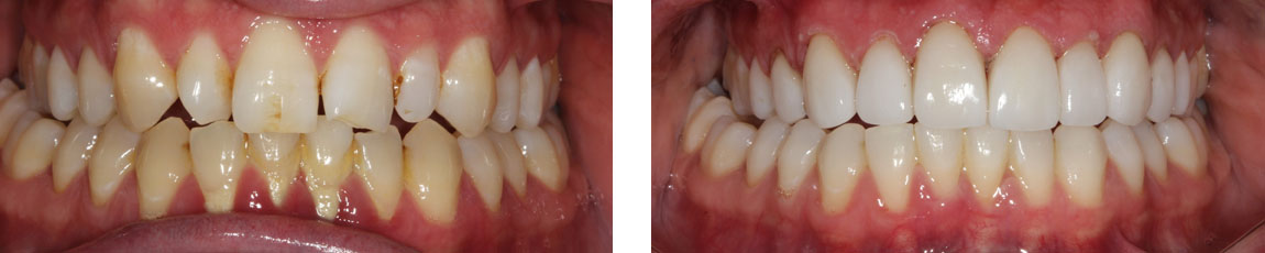 Actual Cases By Dr Ken Teoh and Dr Lisa Guo At EPSOM Dental