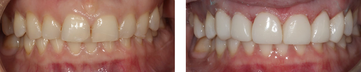 Actual Cases By Dr Ken Teoh and Dr Lisa Guo At EPSOM Dental