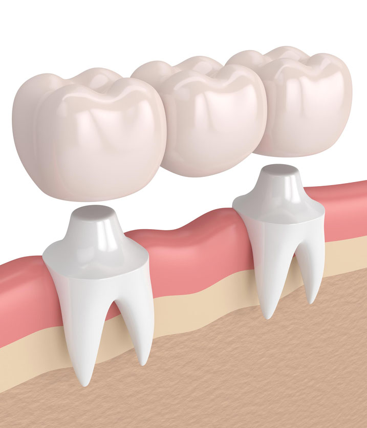 Dental Bridges