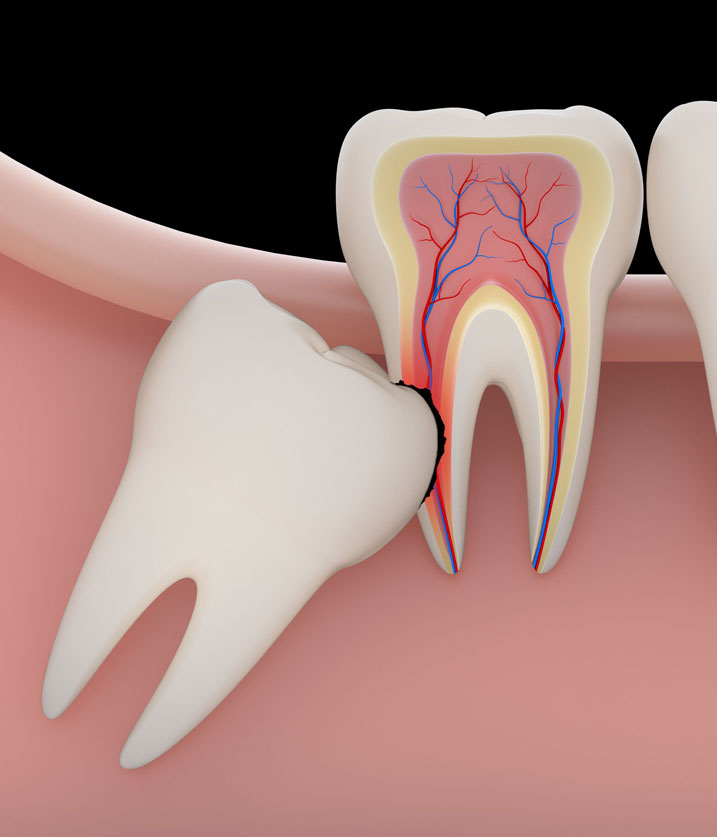 Wisdom Teeth Removal