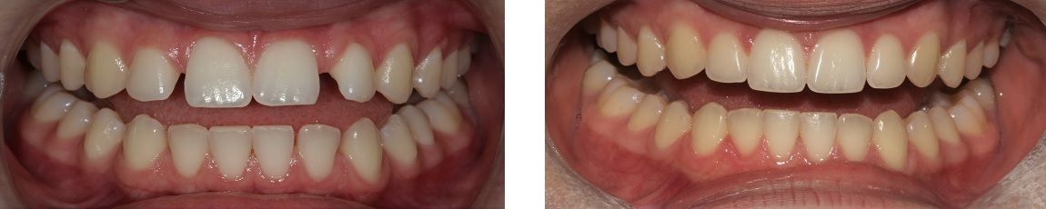 Invisalign treatment before-after