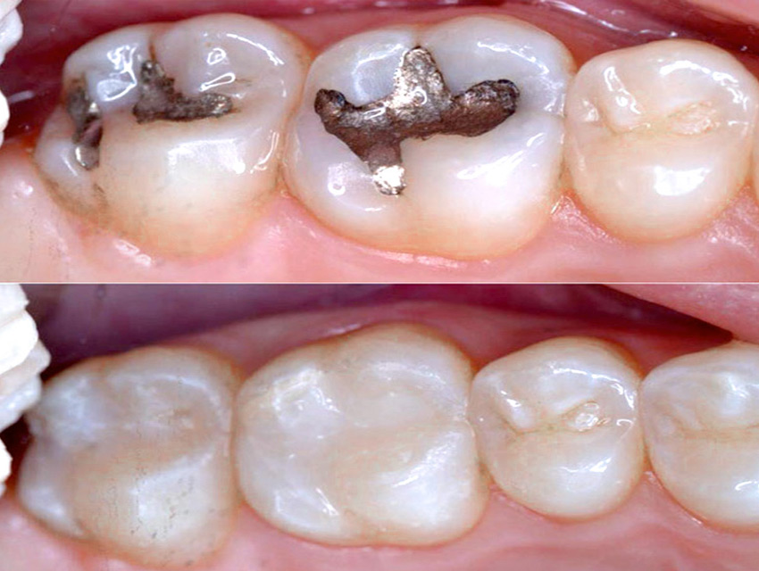 Epsom-Dental-dentist-Bendigo-fillings-01