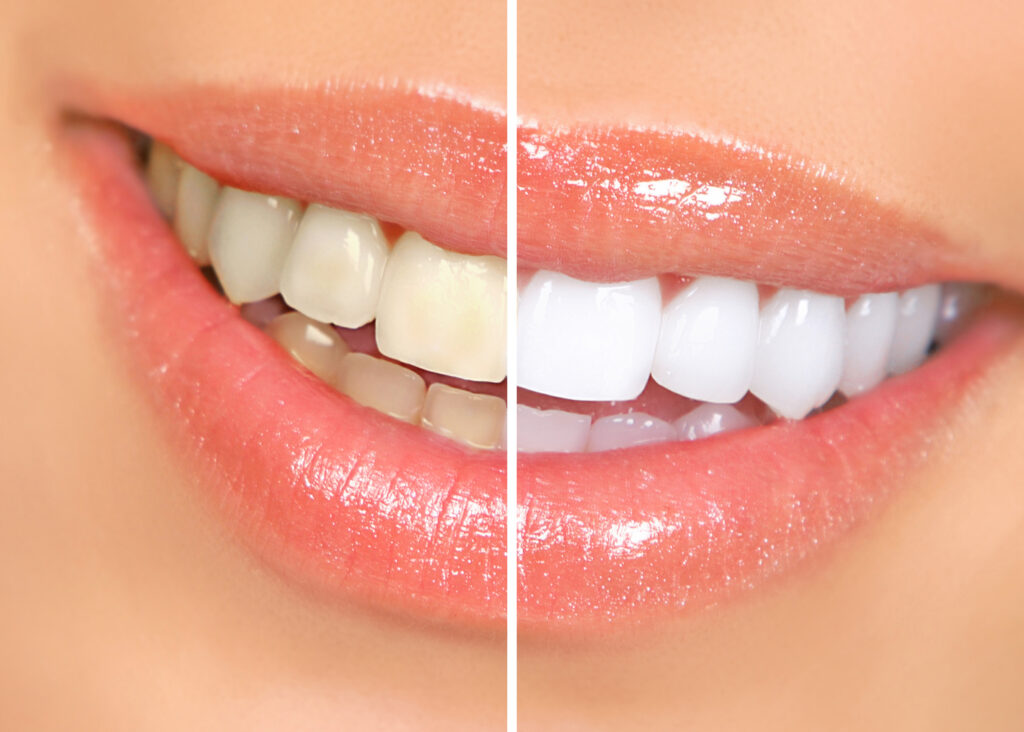 tooth whitening at epsom dental