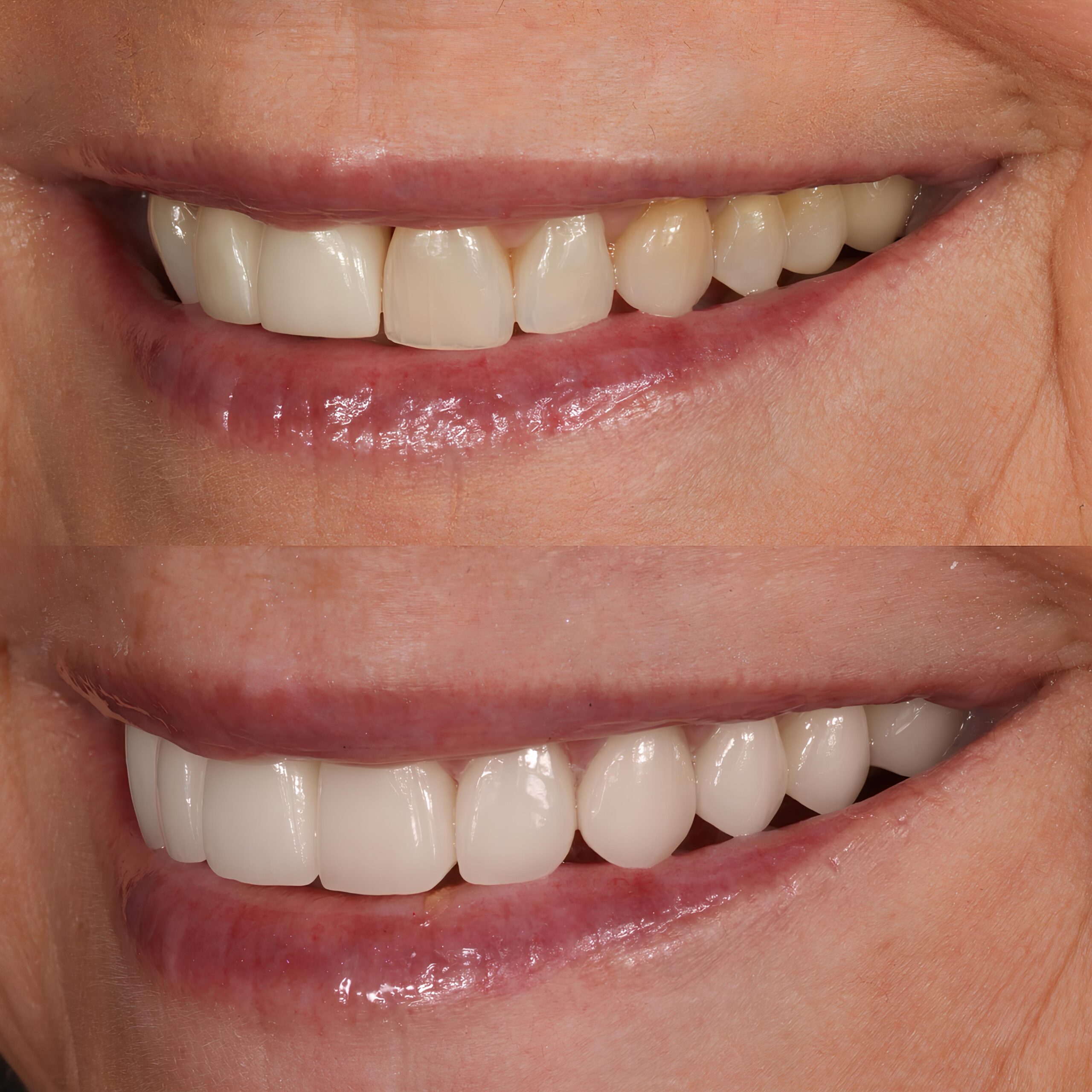 smile makeover with veneers