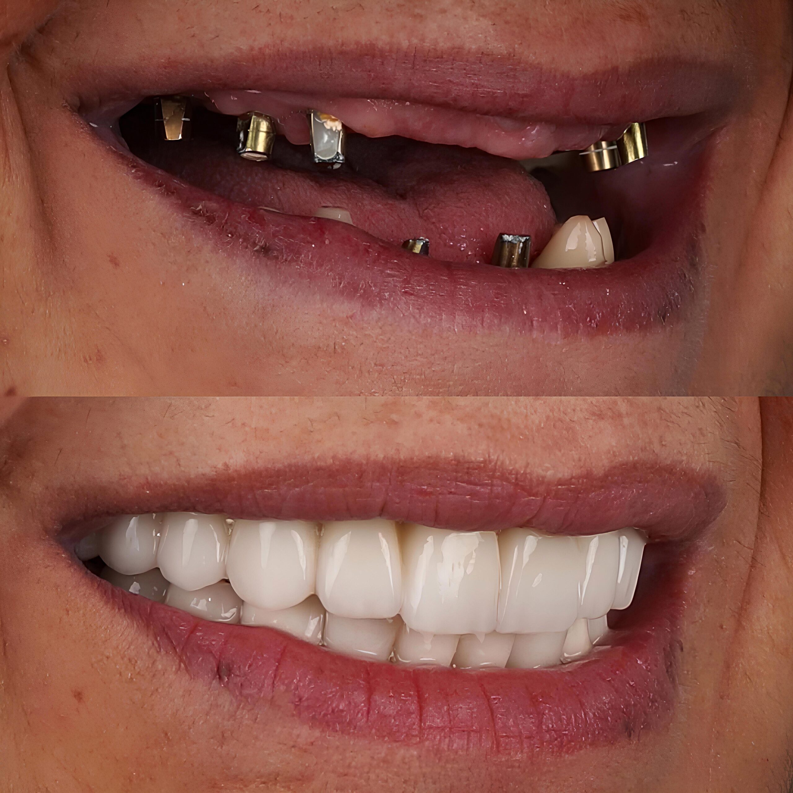 dental implants