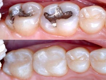 Epsom-Dental-dentist-Bendigo-fillings-01